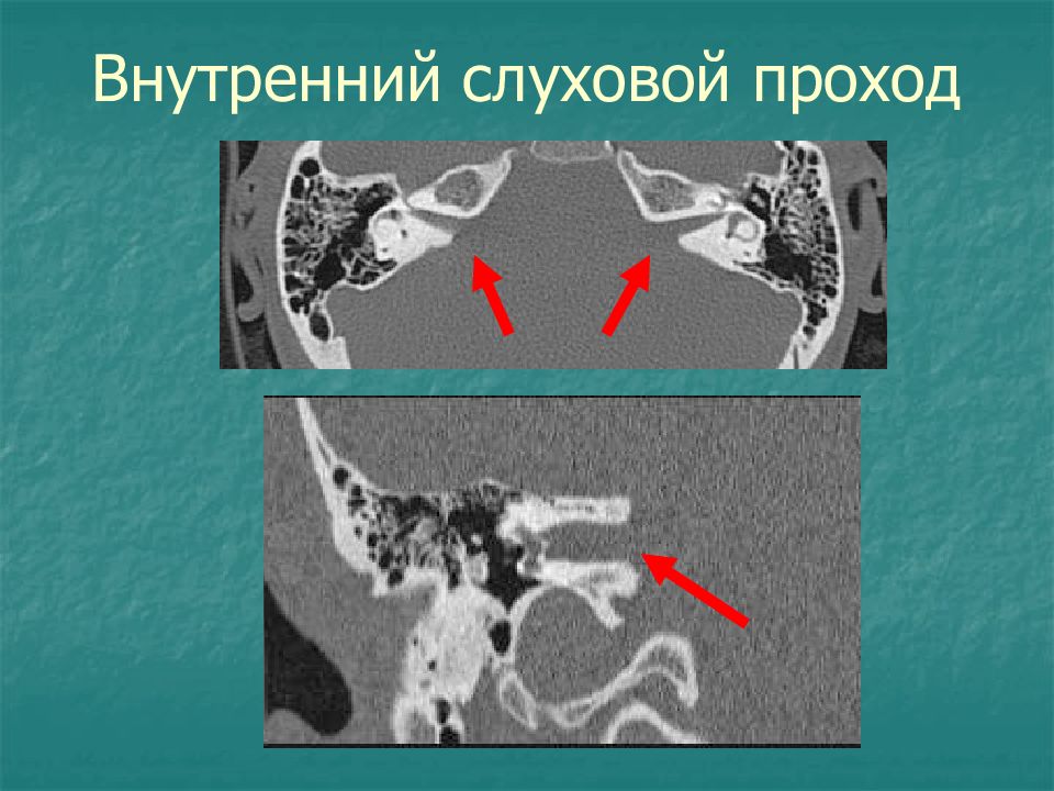 Внутренний слуховой проход. Невринома внутреннего слухового прохода на кт. Внутренний слуховой проход анатомия кт. Височная кость внутренний слуховой проход. Внутренний слуховой проход на кт.