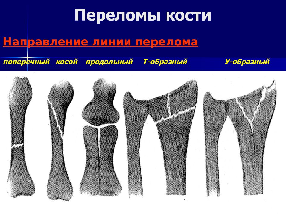 Закрытый перелом костей плюсны карта вызова