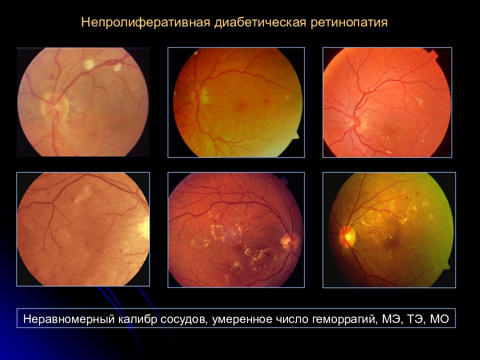 Диабетическая ретинопатия это. Пролиферативная ретинопатия. Пролиферативная диабетическая ретинопатия глазное дно. Непролиферативная диабетическая ретинопатия классификация. Ретинопатия препролиферативная стадия.