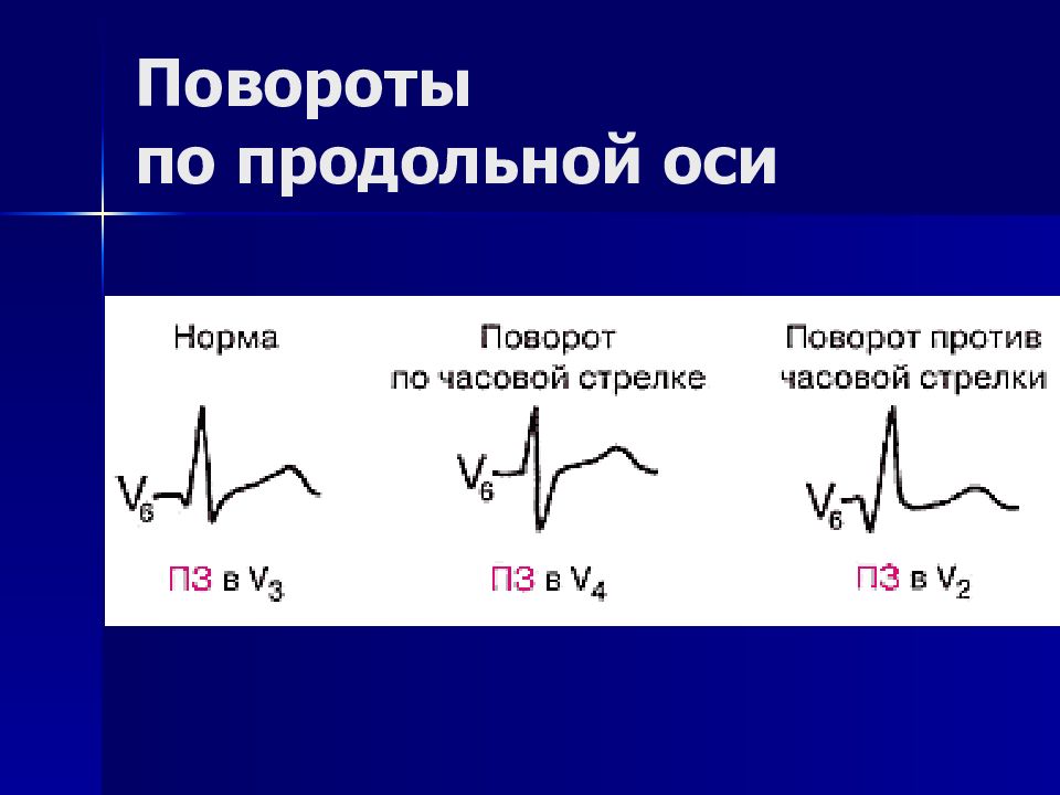 Экг презентация терапия