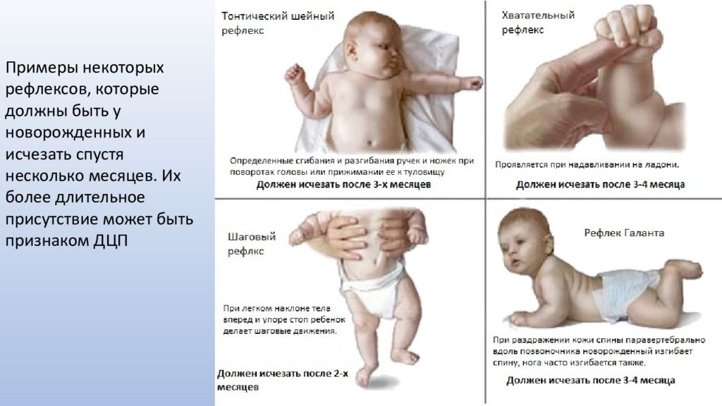 Тонус 6 месяцев. Ранние проявления ДЦП У детей до года. Как определить ДЦП У грудничка 2 месяца. Ранние признаки ДЦП У грудного ребенка до 3 месяцев. Первые симптомы ДЦП У ребенка до года.
