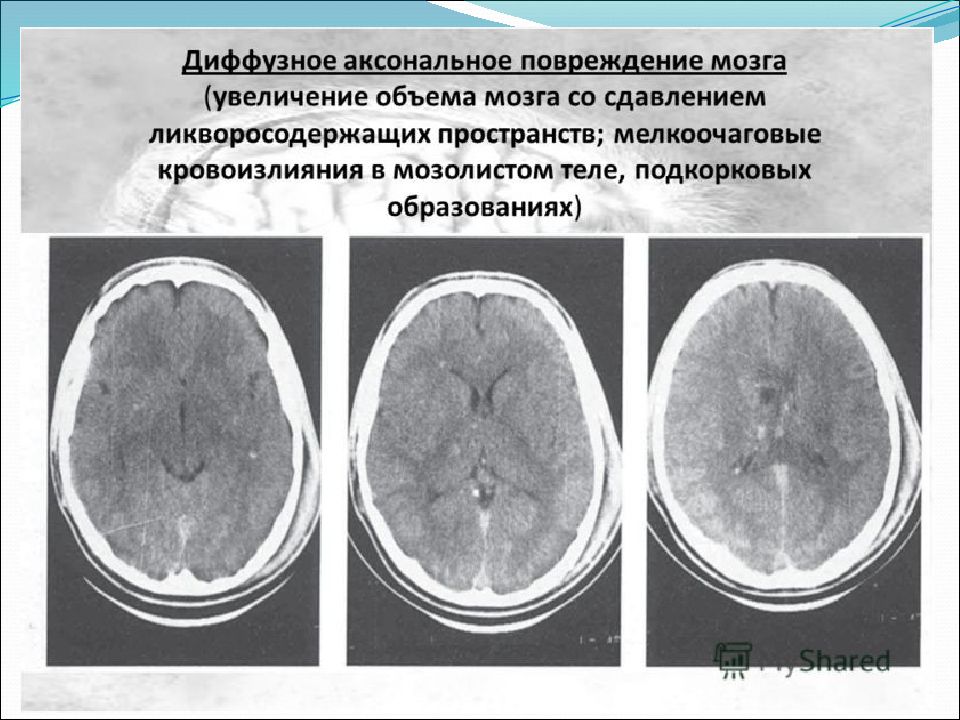 Диффузная травма головного. Диффузное аксональное повреждение головного мозга. Диффузное аксональное повреждение головного мозга кт. Диффузное аксональное повреждение мрт. Травма головного мозга диффузная s06.2.