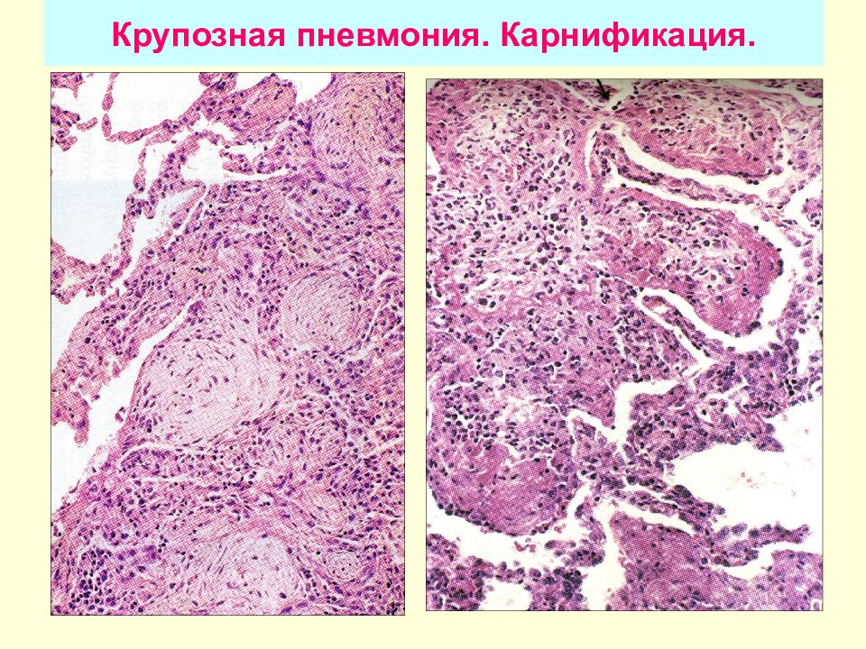 Крупозный трахеит микропрепарат рисунок