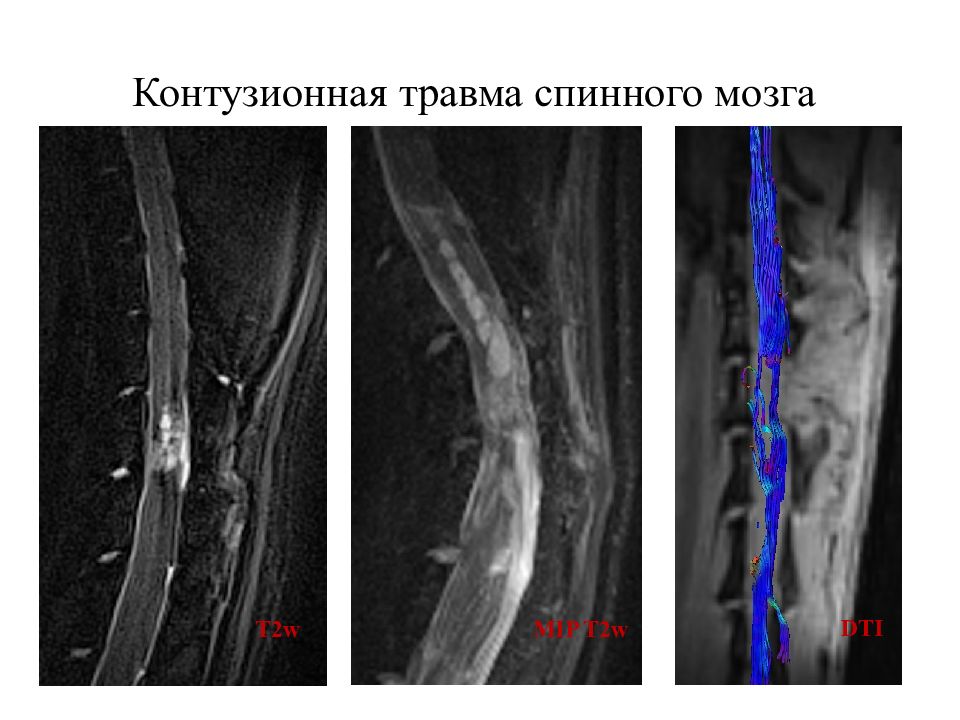 Презентация травмы спинного мозга