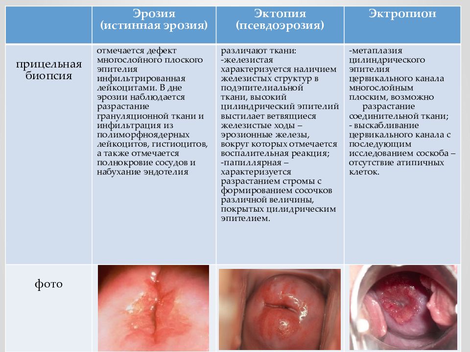 Эктропион шейки матки фото