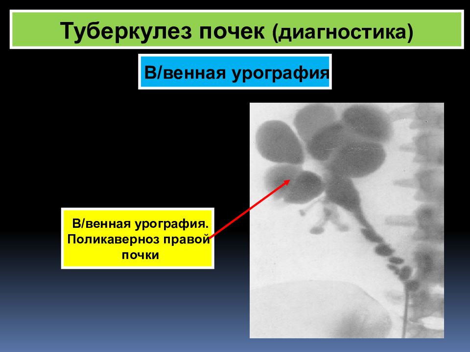 Диагностика почек. Туберкулез почек диагностика. Туберкулез почки рентген. Туберкулез почки урография.