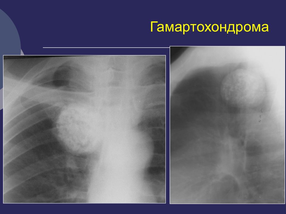 Кисты легких у детей презентация