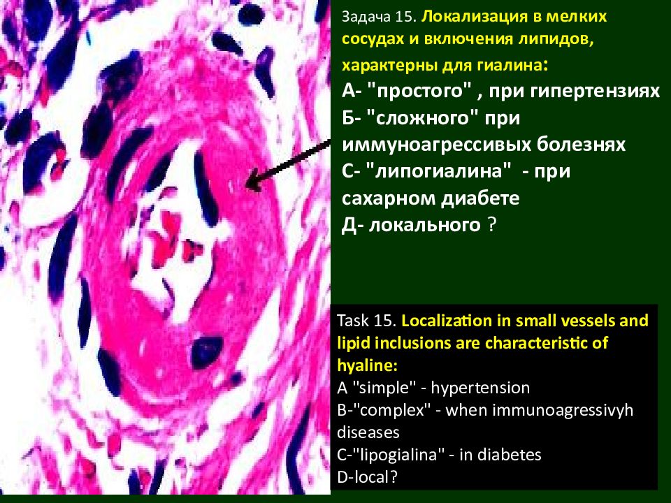 Сахарный диабет патанатомия презентация