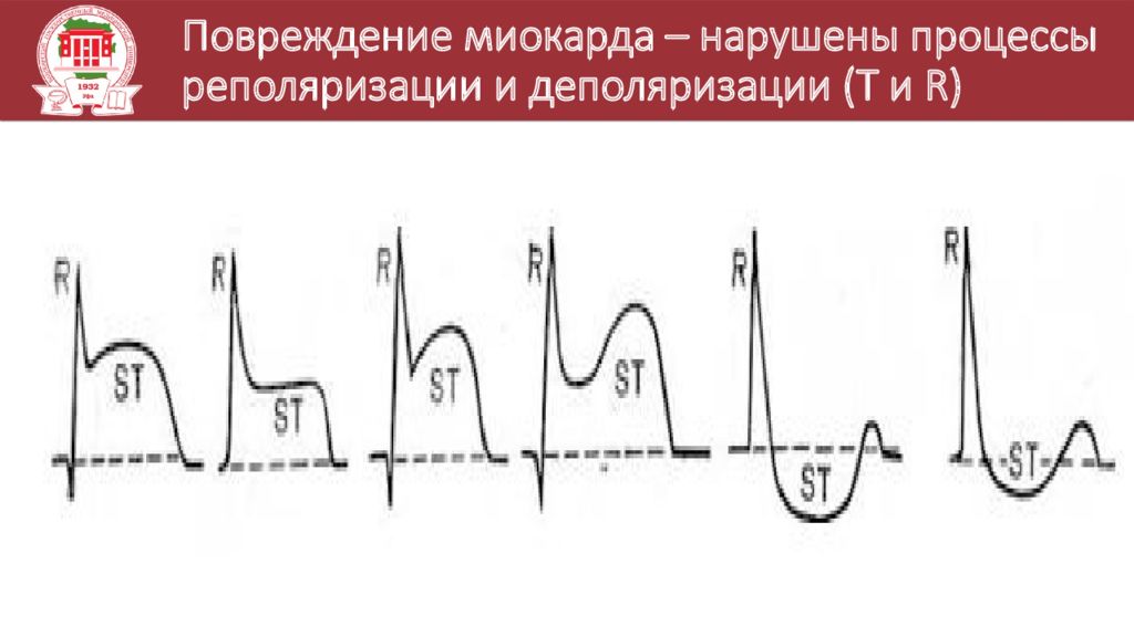 Нарушение процессов реполяризации на экг. Нарушение реполяризации миокарда на ЭКГ. Реполяризация миокарда на ЭКГ. Процессы реполяризации на ЭКГ.