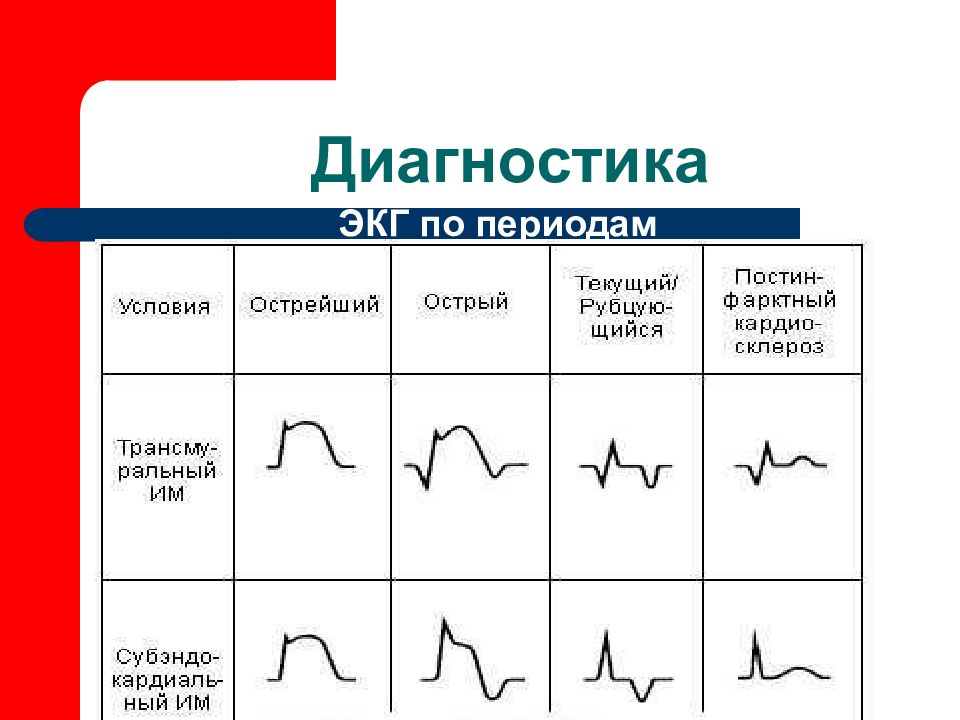 Диагноз миокарда. Диагностика инфаркта миокарда. Диагноз по ЭКГ. Инфаркт миокарда диагно. Зоны инфаркта миокарда рисунок.