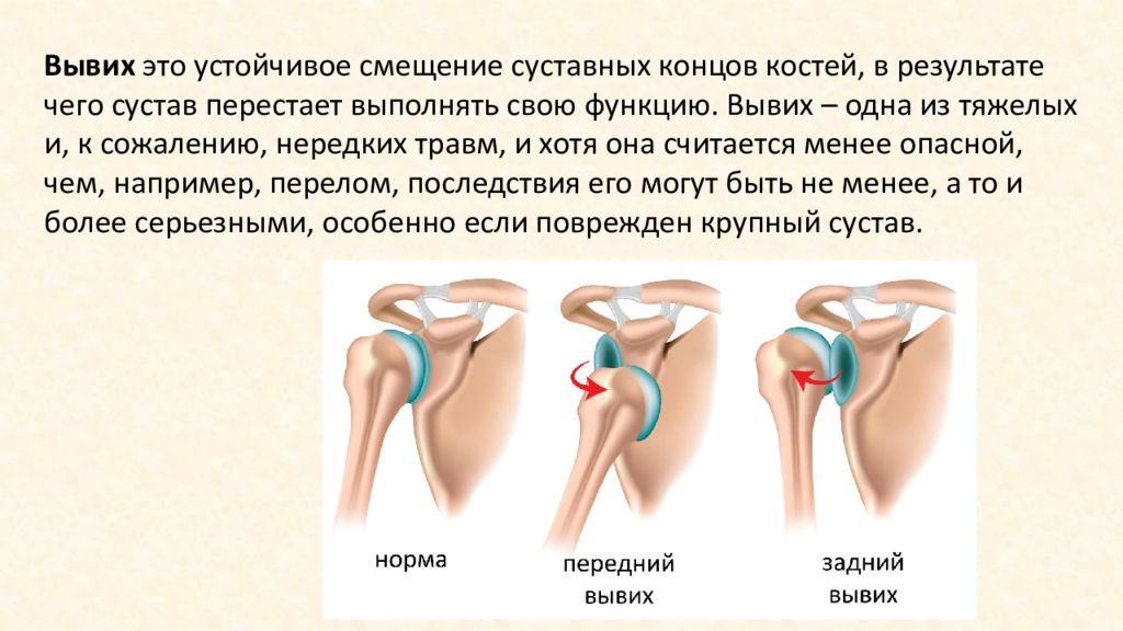 Вывих сустава руки