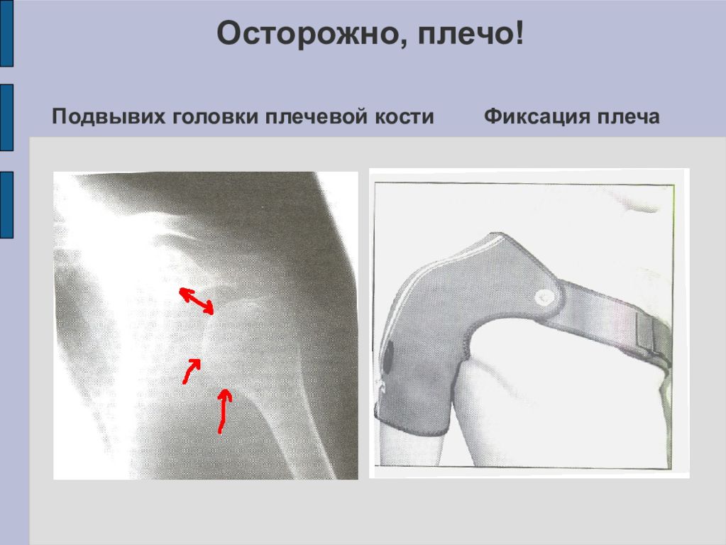 Подвывих. Классификация вывихов плечевой кости. Подвывих плечевой кости. Подвывих головки плечевой кости. Передний подвывих плечевой кости.