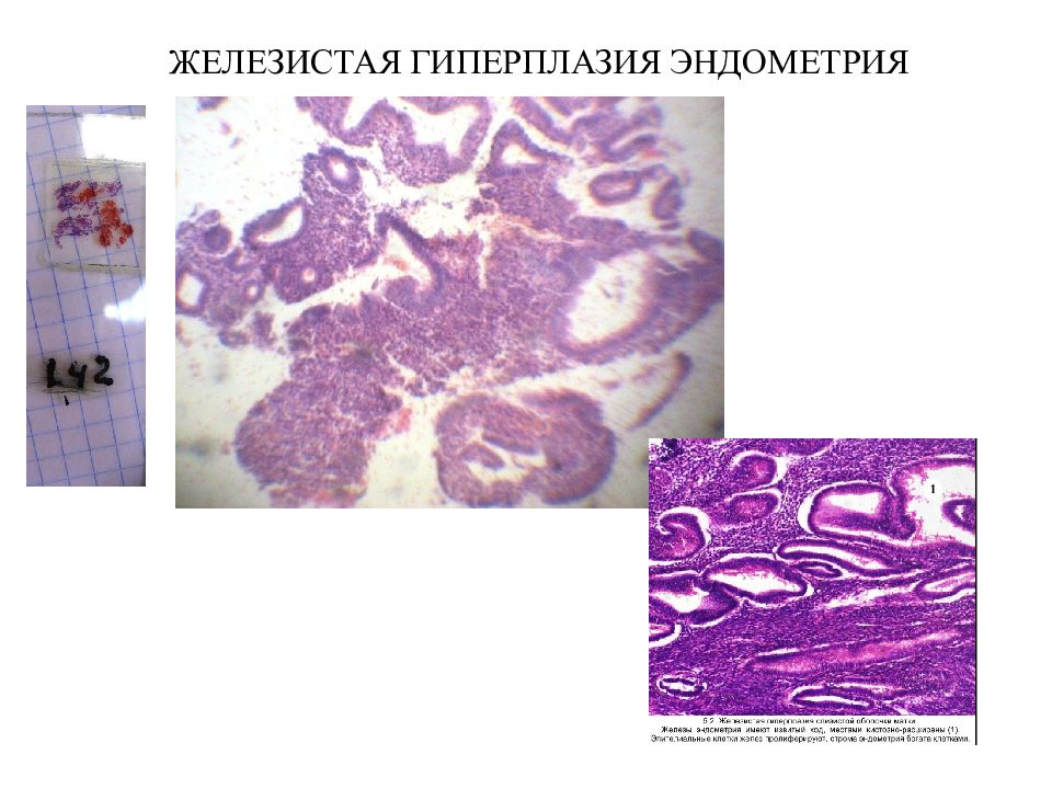 Фрагменты железистого эндометрия. Железисто-кистозная гиперплазия эндометрия микропрепарат. Железистая гиперплазия гистология. Гиперплазия эндометрия гистология. Гиперплазия эндометрий гистология.