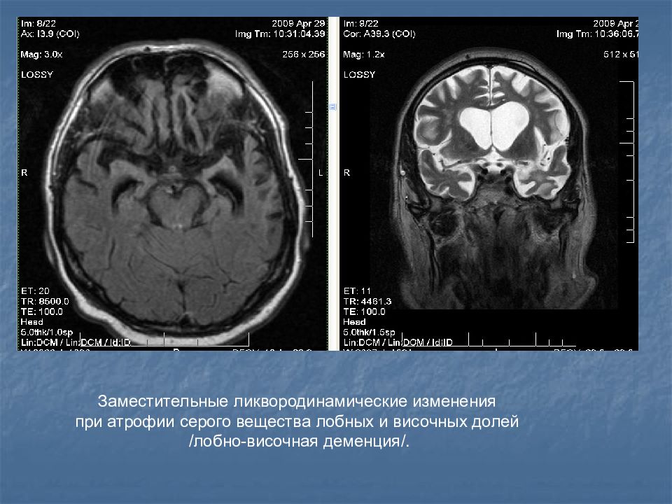 Височно лобная деменция