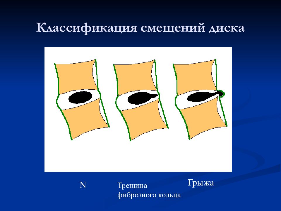 Группы смещений. Классификация смещений. Классификация сдвигов. Радиография. Трещина фиброзного кольца.