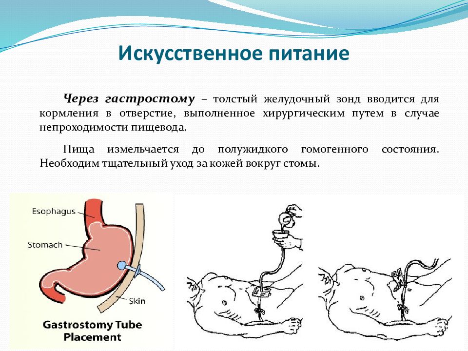 Презентация на тему питание тяжелобольных