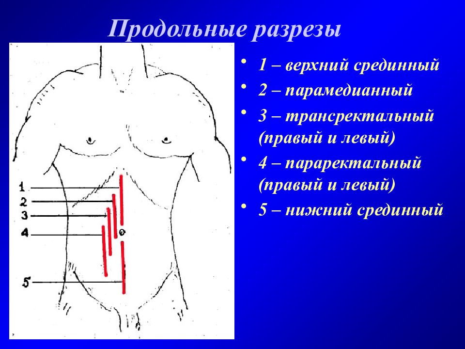 Левый разрез. Схема оперативных доступов к органам брюшной полости. Малоинвазивные и классические доступы к органам брюшной полости. Доступы в брюшную полость. Оперативные доступы к брюшной полости.