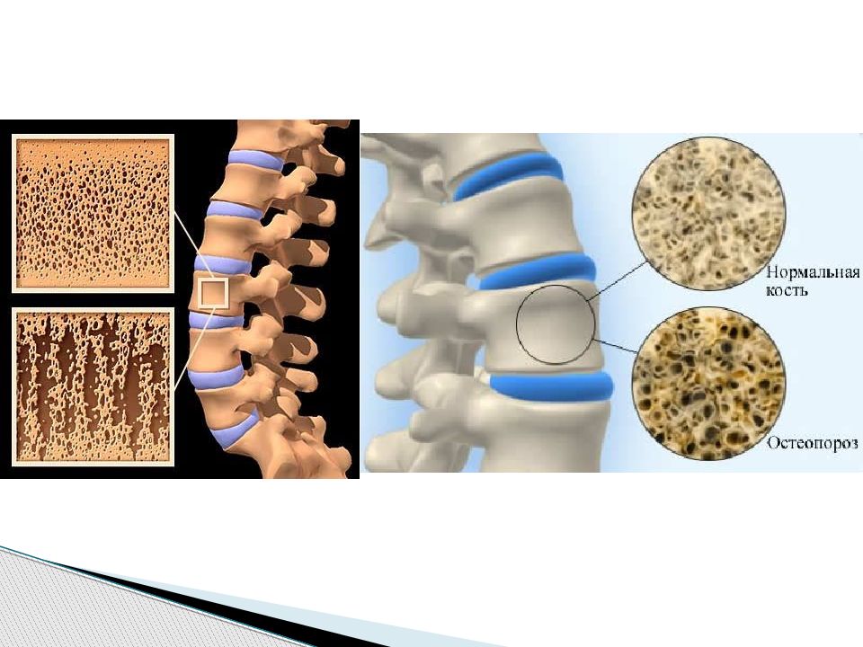 Остеопороз клиническая картина