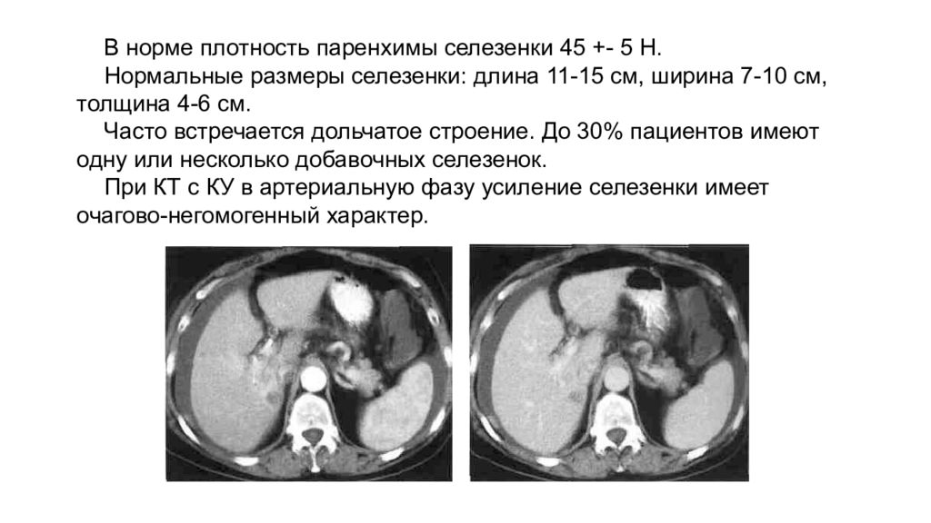 Плотность печени hu. Нормальные Размеры селезенки на кт. Краниокаудальный размер селезенки на кт. Размеры селезенки в норме на кт. Селезенка на кт норма.