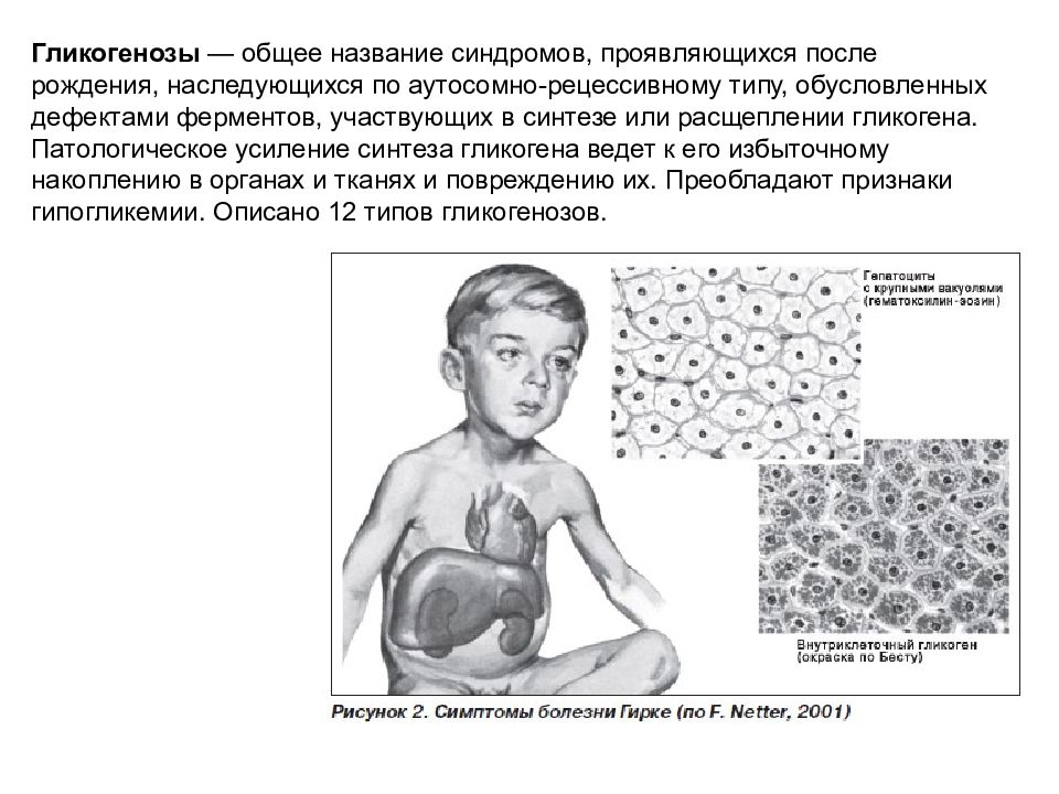 Гликогенозы это. Гликогеновая болезнь Тип наследования. Гликогеноз 1 типа клиника. Гликогеноз болезнь Гирке. Гликогенозы клинические проявления биохимия.