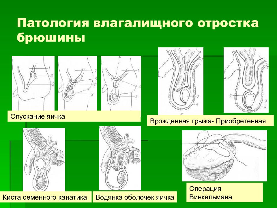 Презентация аномалии яичек