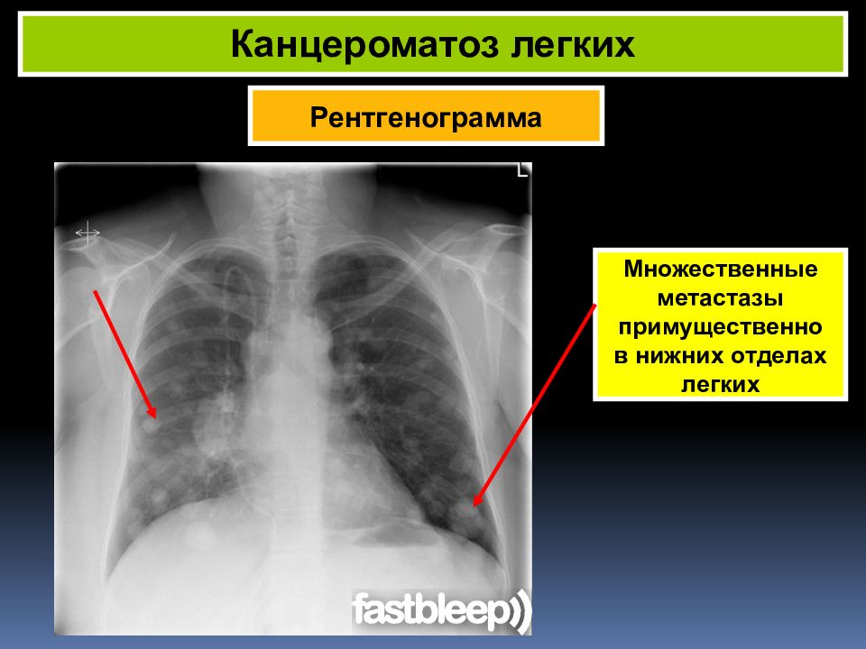 Карциноматоз. Канцероматоз плевры рентген. Милиарный карциноз легких. Милиарный карциноматоз легких. Канцероматоз легких рентген.