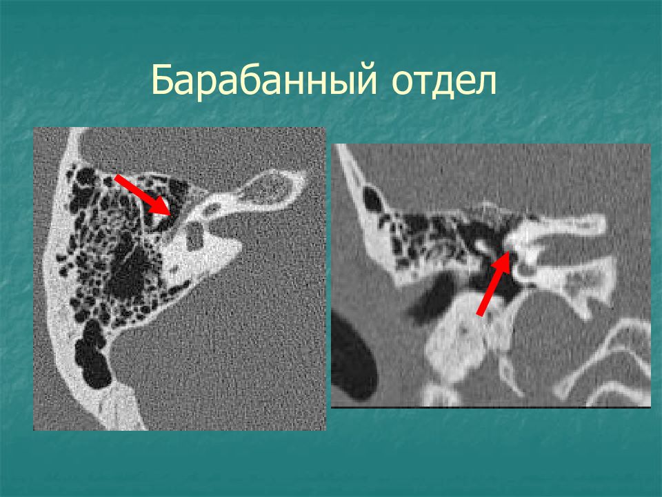 Кт височных костей. Кт сосцевидного отростка височной кости. Кт анатомия сосцевидного отростка. Сосцевидный отросток на кт. Антрум височной кости на кт.