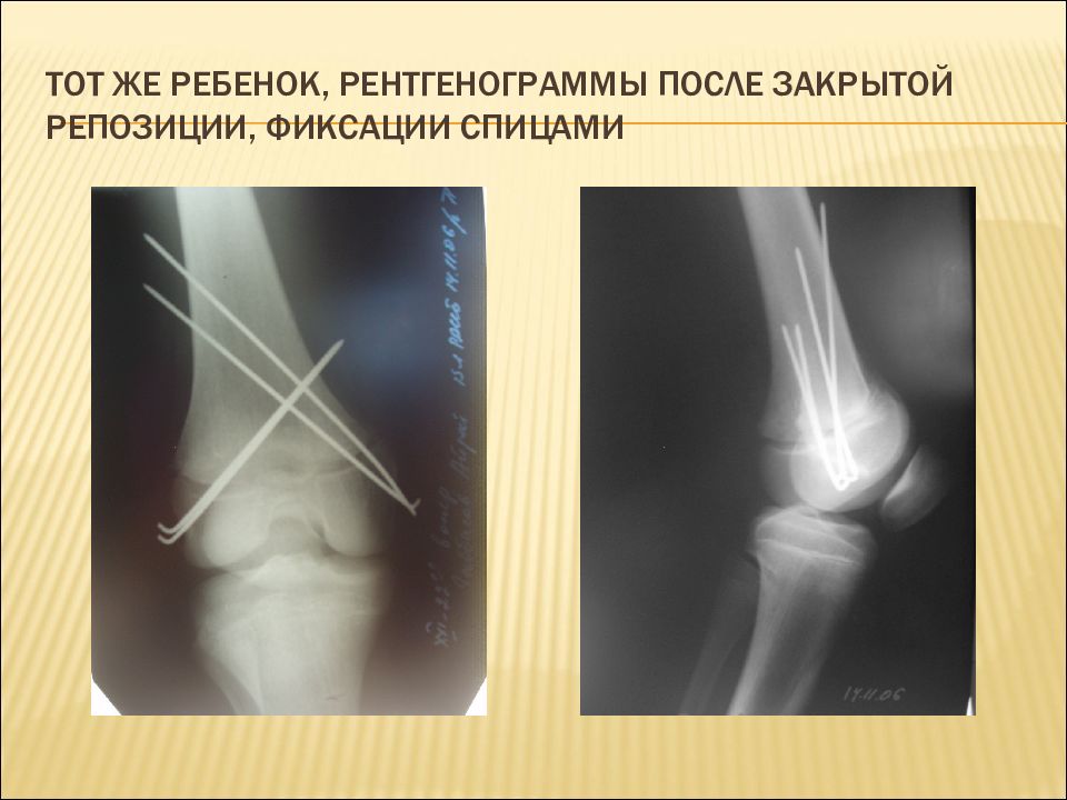 Открытая репозиция костей. Особенности травматологии детского возраста. Трансартикулярная фиксация спицей Киршнера. Методы обследования в травматологии. Закрытая репозиция фиксация спицами.