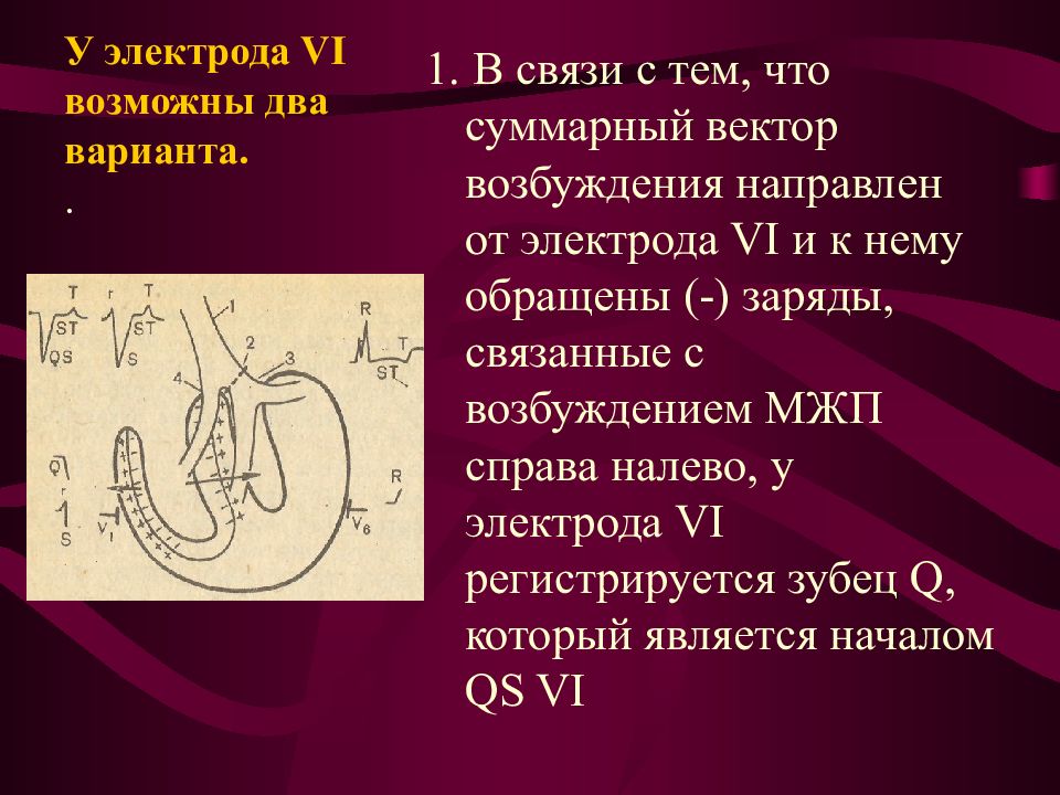 Вектор возбуждения межжелудочковой перегородки. Блокада межжелудочковой перегородки. Электрод в межжелудочковую перегородку. Вектор реполяризации.