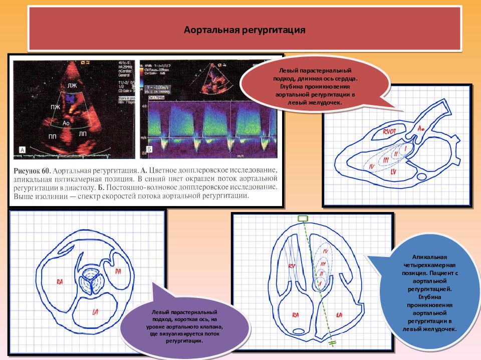 Аортальная регургитация 1 2. Аортальная регургитация. Аортальная регургитация PHT. Аортальная регургитация по УЗИ. Степени регургитации.