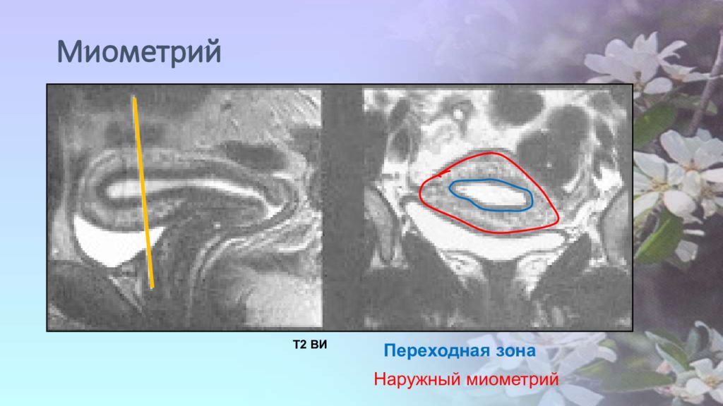 Миометрий это. Переходная зона миометрия.