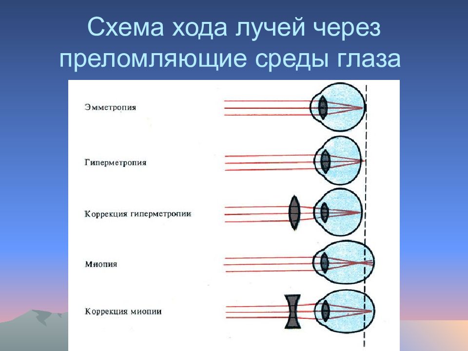 На рисунке представлены схемы хода лучей в глазе человека при нормальном зрении близорукости