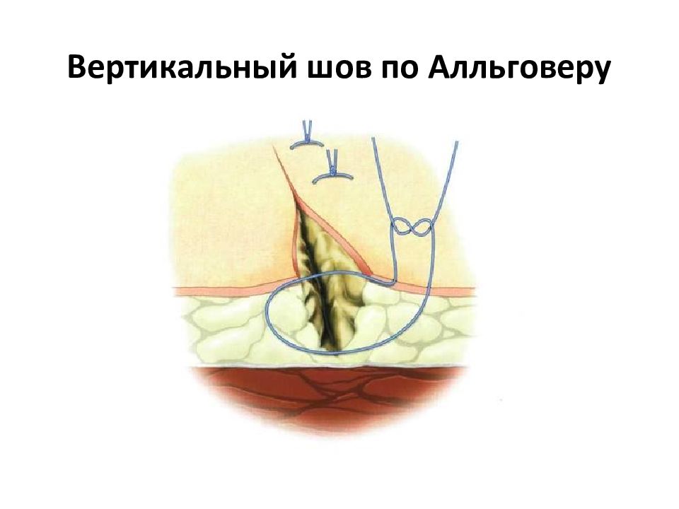 Вертикальный шов. Вертикальный шов на лопатке от торпеды.