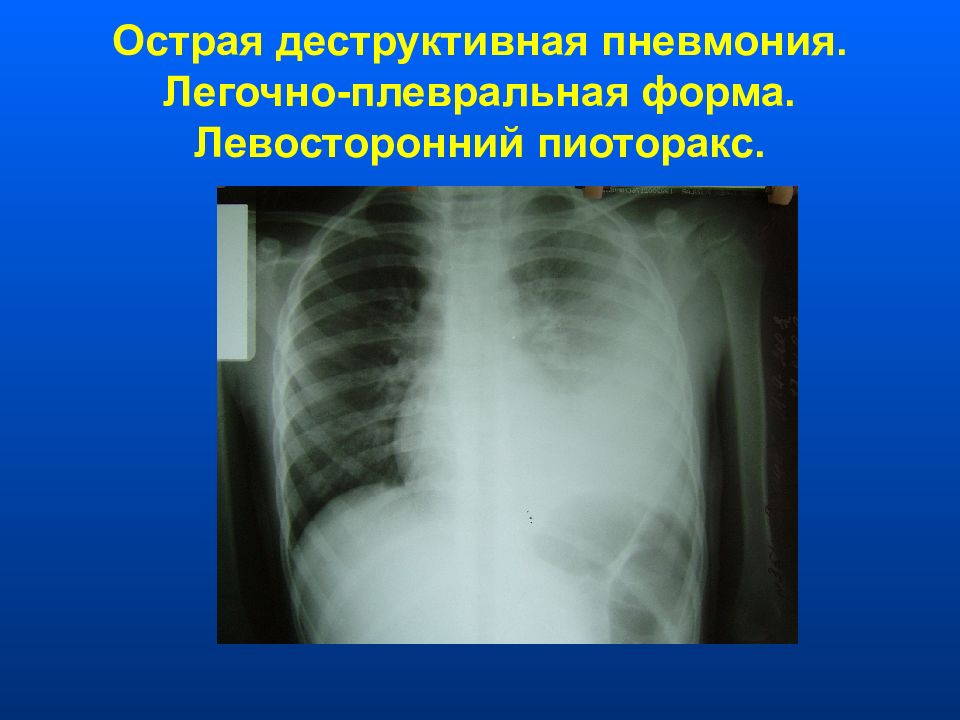 Острая пневмония у детей презентация