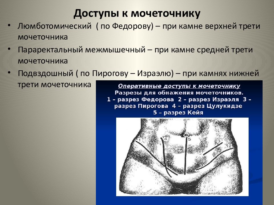 Нижняя треть мочеточника. Доступы к почкам и мочеточникам. Оперативные доступы к почкам и мочеточникам. Люмботомический доступ.