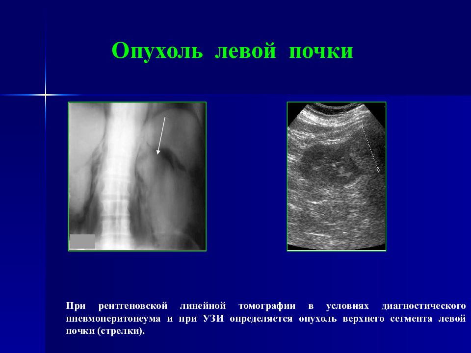 Опухоль левой. Объемное образование левой почки. УЗИ признаки пневмоперитонеума. Лучевая диагностика пневмоперитонеума.