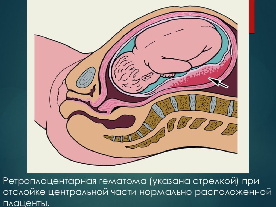 Плацента на рубце матки. Краевая и Центральная отслойка плаценты. Предлежание плаценты и отслойка нормально расположенной плаценты. Отслойка плаценты патанатомия. Ретроплацентарная отслойка плаценты.