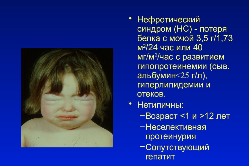 Синдром утраты. Степени синдрома утраты. Нефротический синдром белок. Синдром утраты. Синдром потери плода.