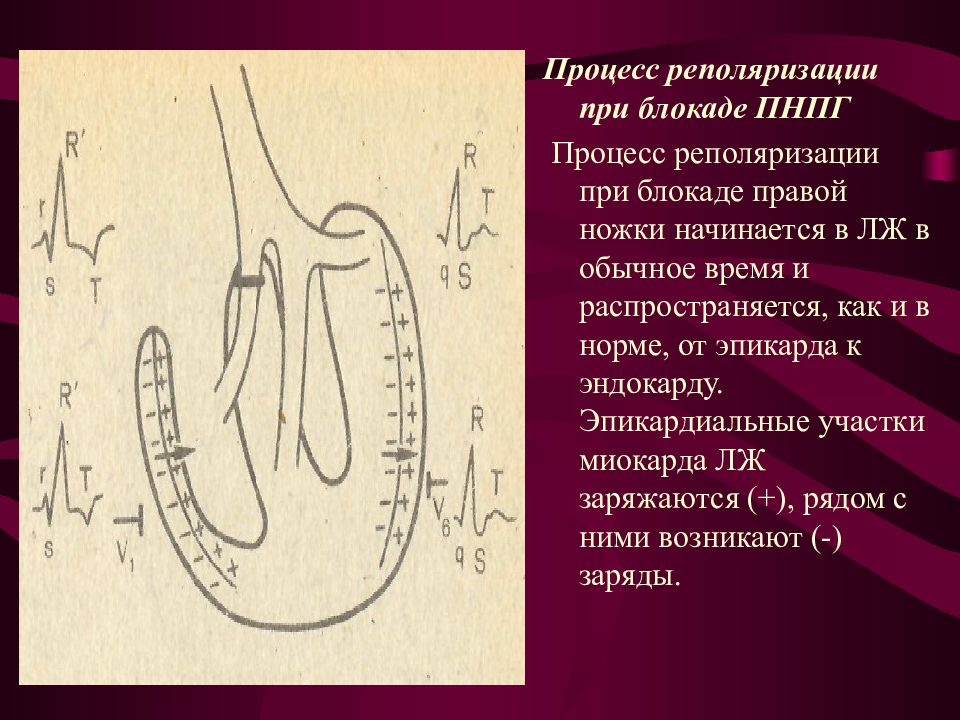 Нарушение процессов реполяризации в миокарде что это. Процесс реполяризации. Реполяризация процессы. Блокада ножек пучка Гиса презентация. Реполяризация миокарда.