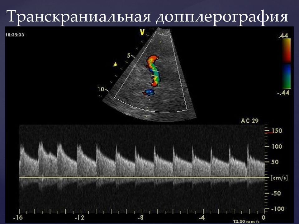Транскраниальная ультразвуковая допплерография. Транскраниальная ультразвуковая допплерография сосудов головного. Транскраниальный датчик УЗИ. Транскраниальных артерий и вен