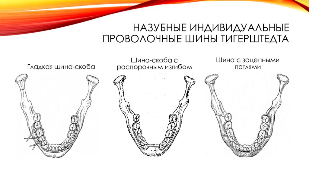 Шинирование челюсти схема при переломе нижней челюсти