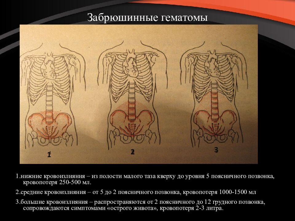 Забрюшинная гематома