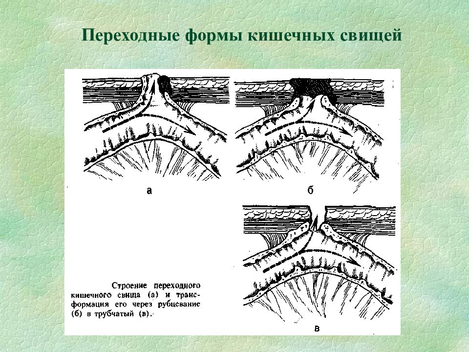 Лечение кишечных свищей