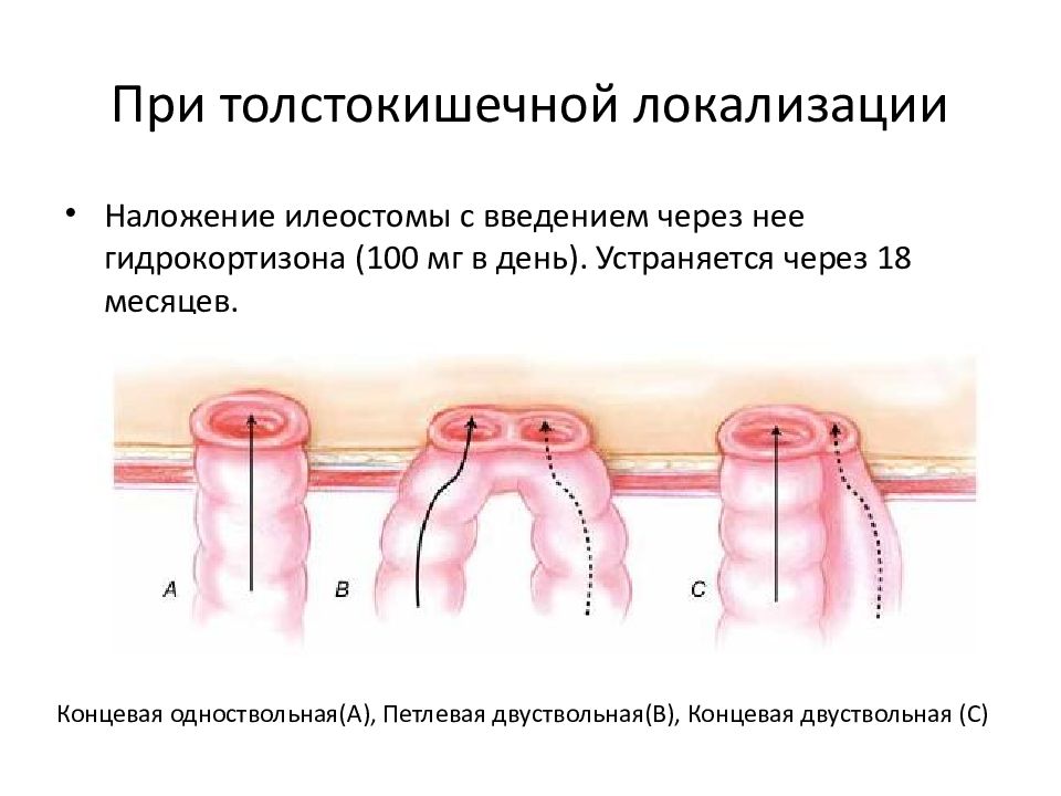 Выпадение колостомы карта вызова