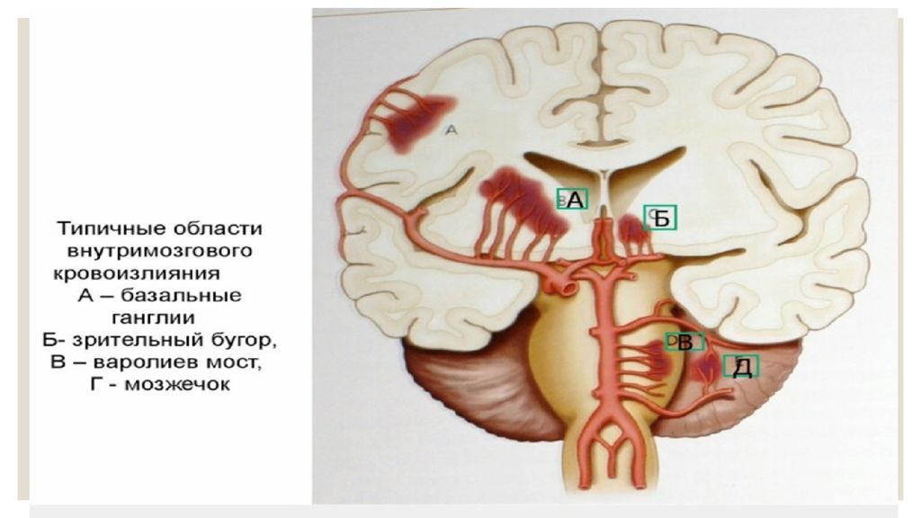 Кровоизлияние в полушарие. Внутримозговое кровоизлияние. Внутримозговое кровоизлияние в полушарие кортикальное. Внутримозговое кровоизлияние кортикальное что это. Внутримозговое кровоизлияние инсульт.