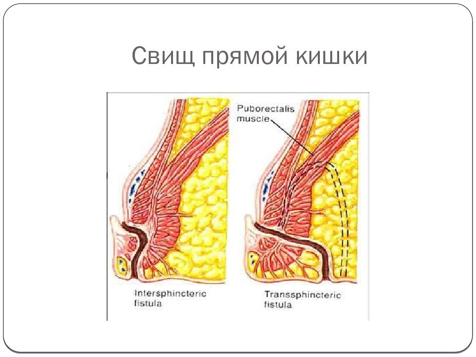 Как выглядит свищ после операции на шве