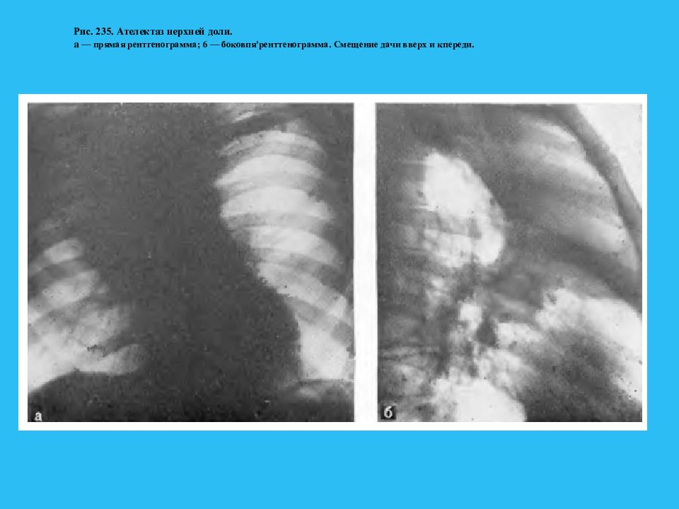 Ателектаз легкого мкб 10. Рентгенография с прямым увеличением изображения. Ателектаз легкого презентация. Ателектаз на рентгене. Ателектаз легкого УЗИ картина.