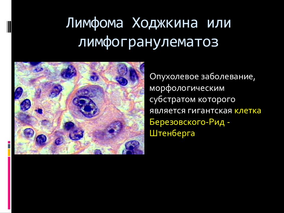 Лимфоидная опухоль. Лимфоидные клетки при лимфопролиферативных заболеваниях. Лимфоцитарная лимфома Ходжкина. Нодулярная лимфома Ходжкина клетки. Лимфома Ходжкина лимфоузлы поражение.