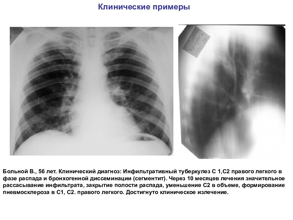 Клиническая картина инфильтративного туберкулеза легких характеризуется обычно