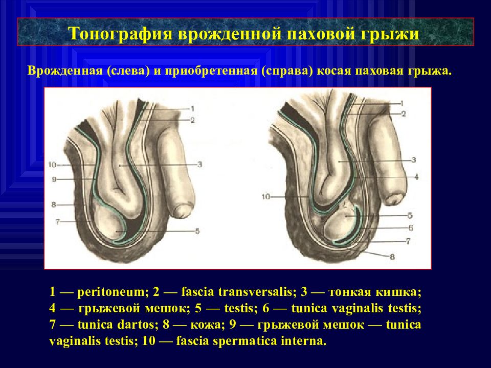 Грыжи у детей презентация